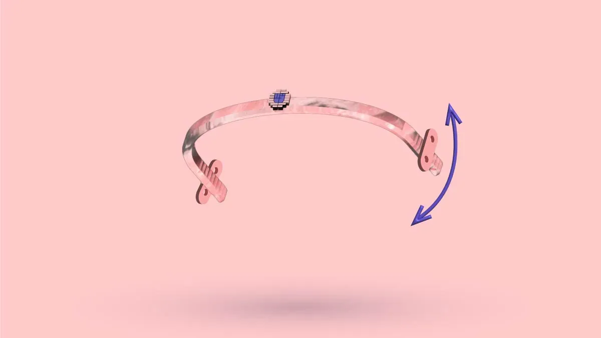 A 3D Nuss bar with curved arrows showing it rotating out of position