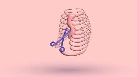 A 3D rib cage with surgical scissors crossed over the sunken sternum
