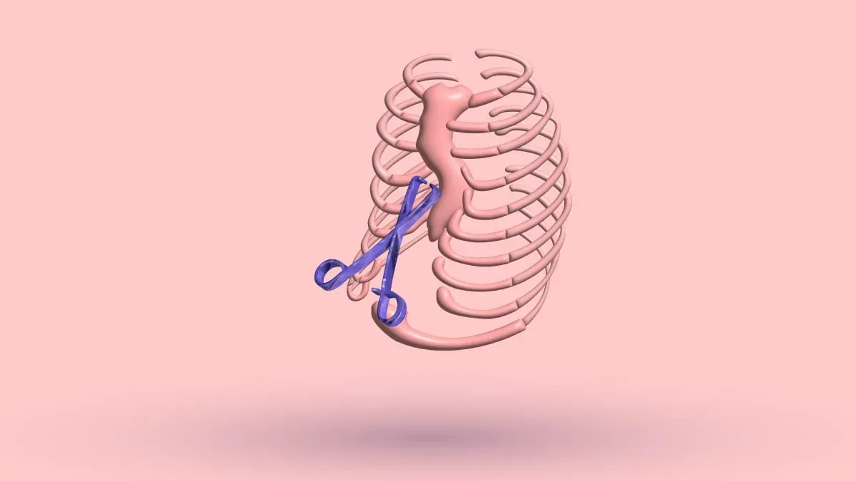 A 3D rib cage with surgical scissors crossed over the sunken sternum