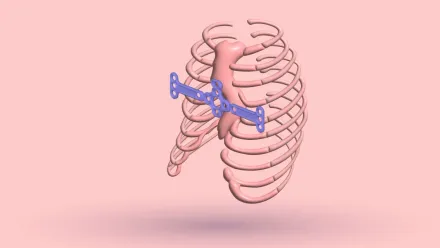 A 3D rib cage with a metal plate bridged across the sternum
