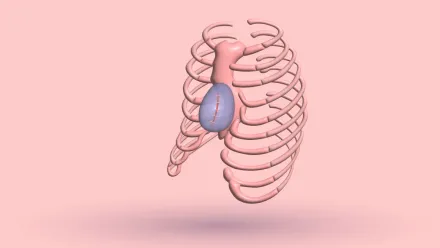 A 3D rib cage with a stitched implant filling the hollow beside the sternum