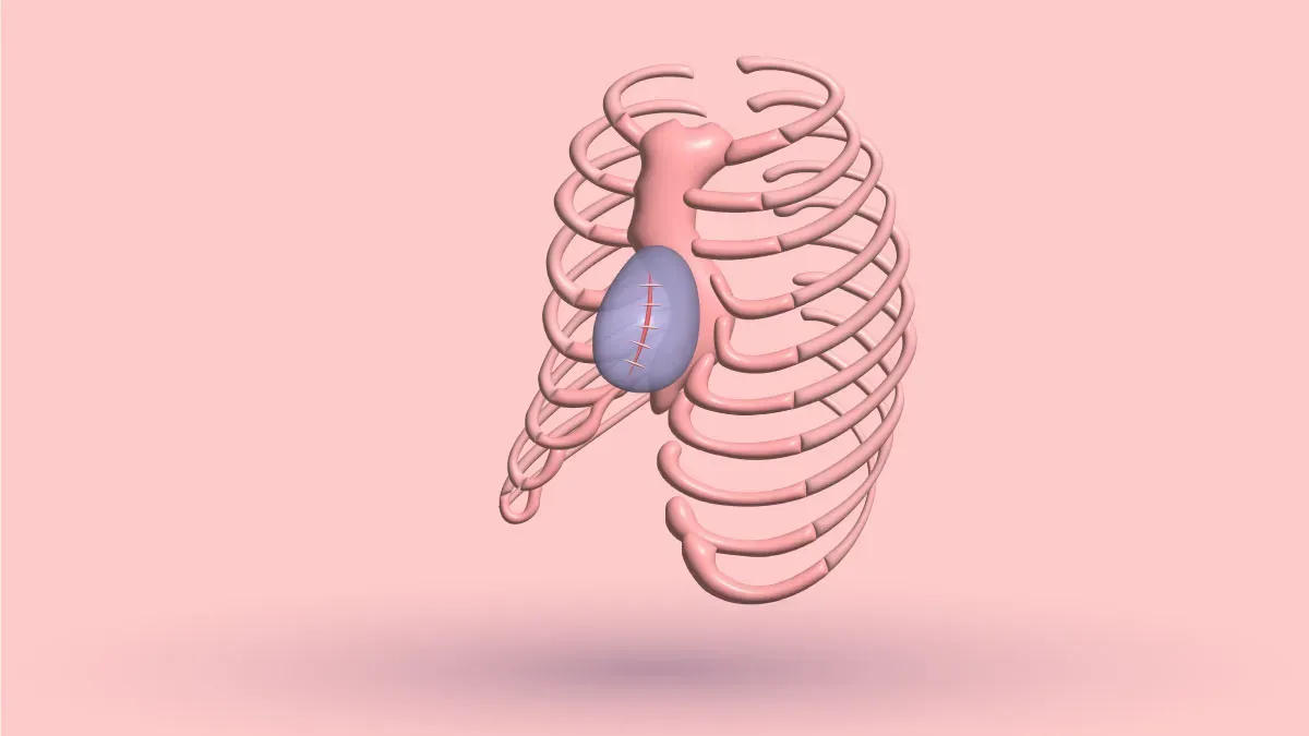 A 3D rib cage with a stitched implant filling the hollow beside the sternum
