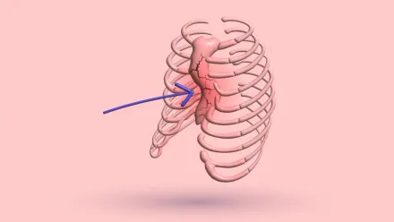 A 3D rib cage with a cracked, reddened sternum and an arrow pointing at it