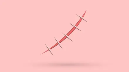 A 3D surgical scar closed with four stitches