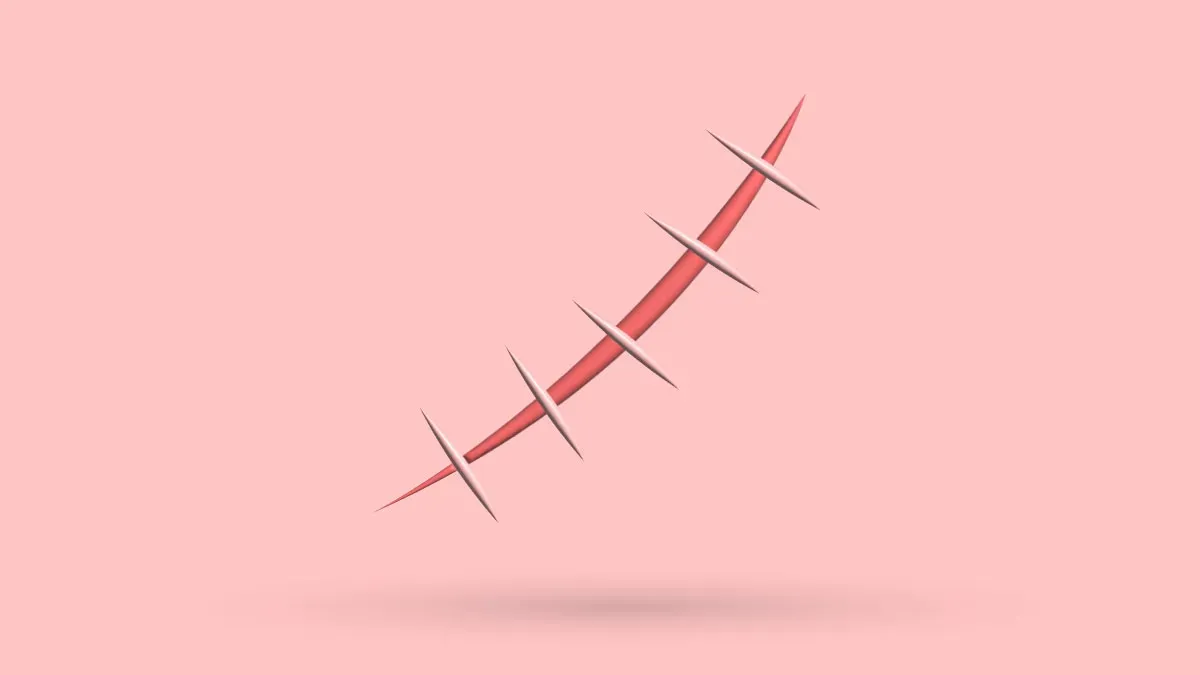 A 3D surgical scar closed with four stitches